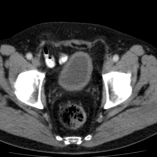 File:Bilateral direct inguinal herniae (Radiopaedia 17016-16719 B 15).jpg
