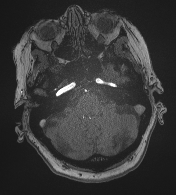 Bilateral fetal posterior communicating arteries (Radiopaedia 41286-44102 Axial MRA 35).png