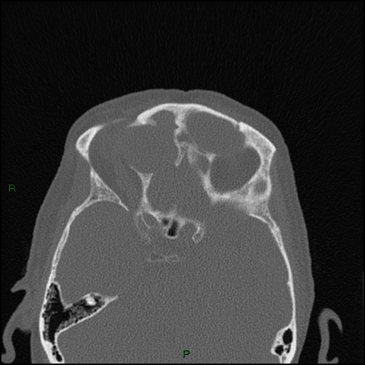 Bilateral frontal mucoceles (Radiopaedia 82352-96454 Axial bone window 119).jpg