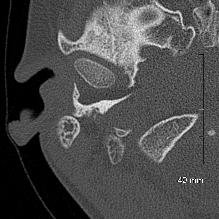 Bilateral grommets (Radiopaedia 47710-52404 Axial bone window 10).jpg