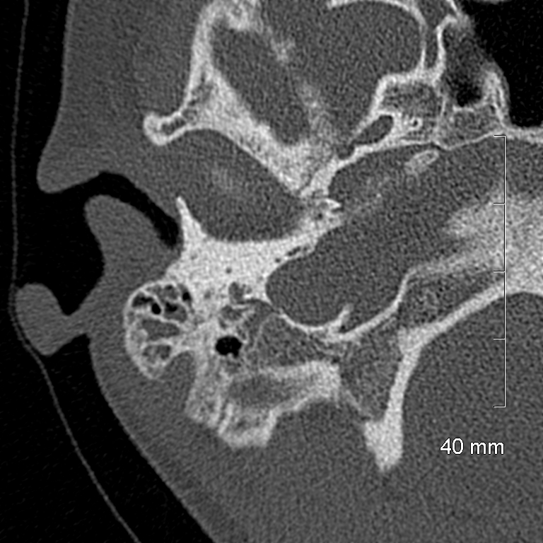 Bilateral grommets (Radiopaedia 47710-52404 Axial bone window 17).jpg