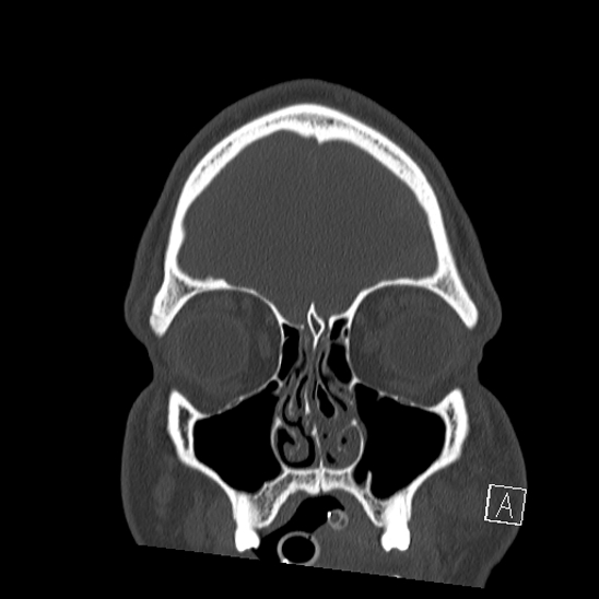 Bilateral occipital condyle fracture (type 2) (Radiopaedia 87675-104089 Coronal bone window 7).jpg