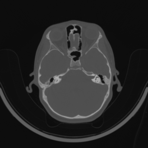 Bilateral otosclerosis (Radiopaedia 57237-64157 C 55).jpg
