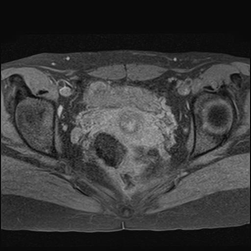 File:Bilateral ovarian endometriomas (Radiopaedia 87085-103347 Axial T1 fat sat 14).jpg
