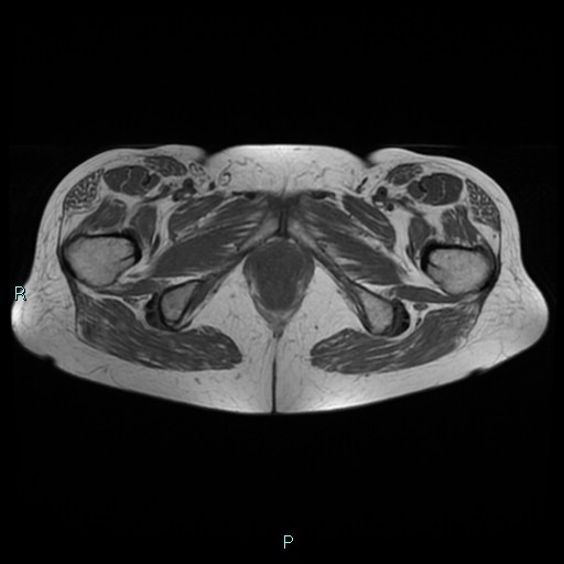 File:Bilateral ovarian fibroma (Radiopaedia 44568-48293 Axial T1 28).jpg