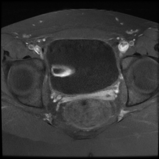 File:Bilateral ovarian fibrothecomas - adolescent (Radiopaedia 86604-102707 Axial T1 C+ fat sat 21).jpg