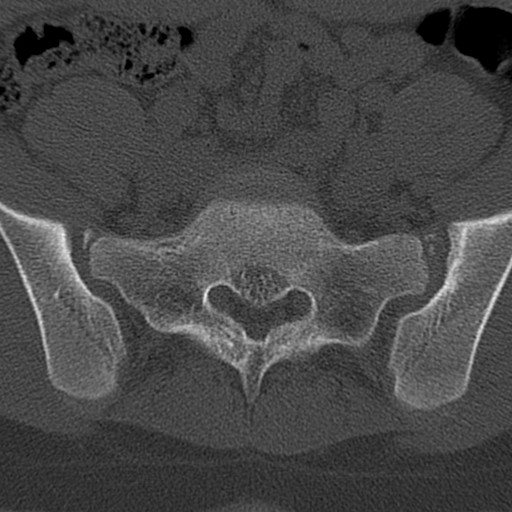 Bilateral pars defect (Radiopaedia 26691-26846 Axial bone window 80).jpg