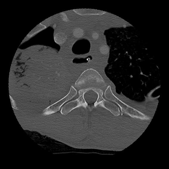 Bilateral perched facets with cord injury (Radiopaedia 45587-49713 Axial bone window 121).jpg