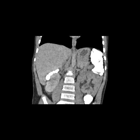 File:Bilateral renal malrotation (Radiopaedia 30901-31606 B 12).jpg