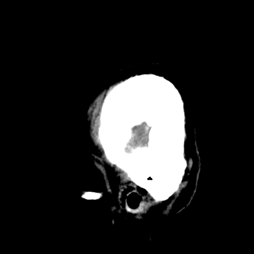 File:Bilateral subacute subdural hematoma (Radiopaedia 69240-79018 C 3).jpg
