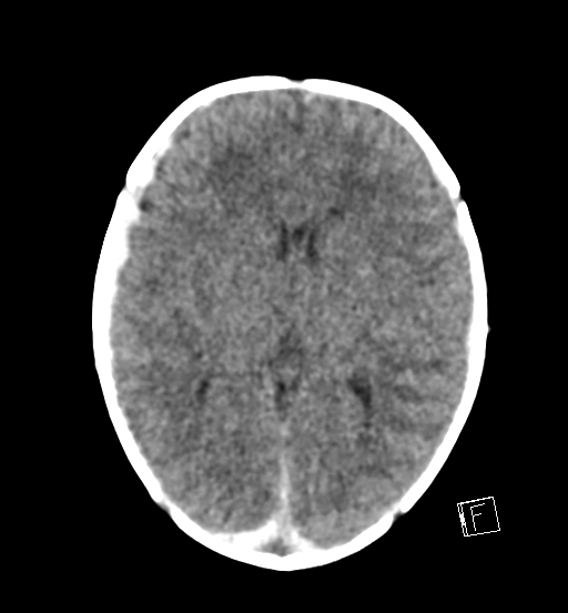 File:Bilateral subdural hemorrhage and parietal skull fracture (Radiopaedia 26058-26192 Axial non-contrast 12).png