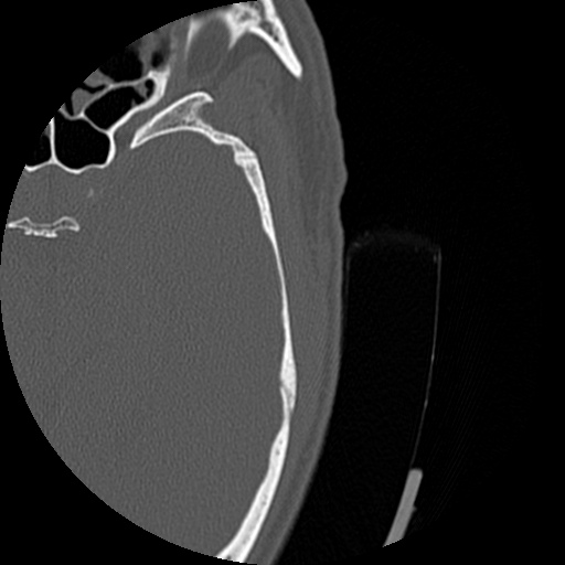 File:Bilateral temporal bone fractures (Radiopaedia 29482-29970 Axial 182).jpg