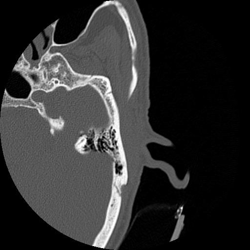Bilateral temporal bone fractures (Radiopaedia 29482-29970 D 101).jpg