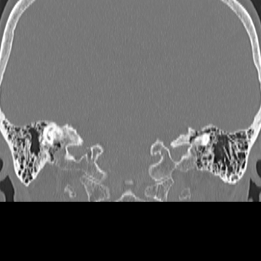 File:Bilateral tympanoplasty (Radiopaedia 16947-16664 Coronal bone window 21).jpg