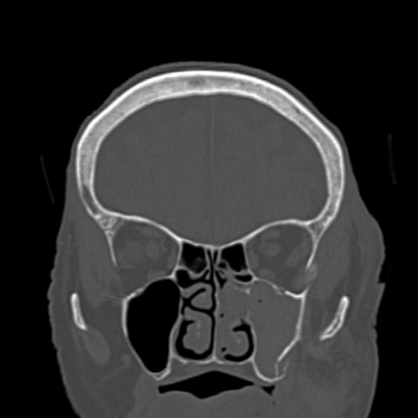 Biparietal osteodystrophy (Radiopaedia 46109-50463 Coronal bone window 31).jpg