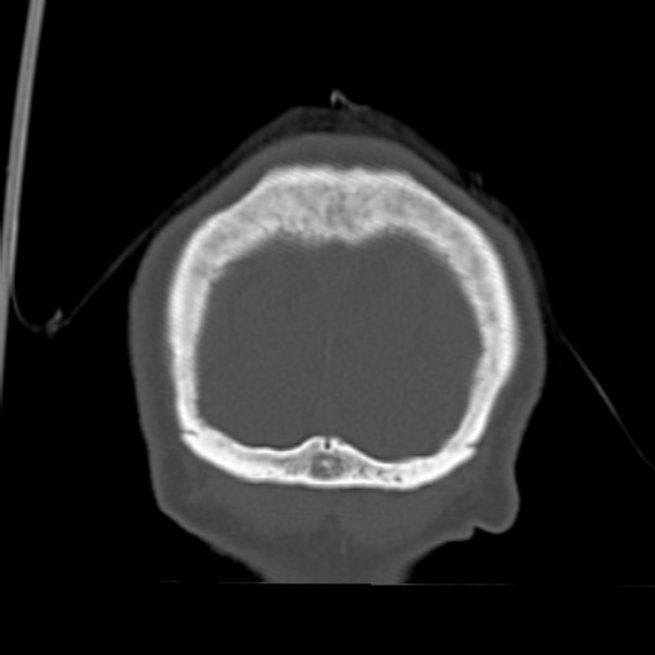 Biparietal osteodystrophy (Radiopaedia 46109-50463 Coronal bone window 98).jpg