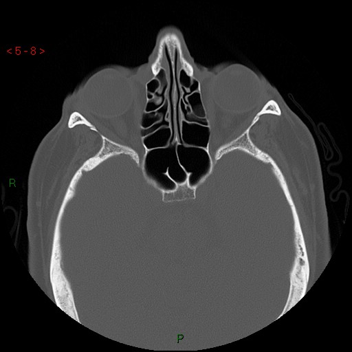 Bisphosphonate-related osteonecrosis of the jaw (Radiopaedia 54147-60329 Axial bone window 2).jpg