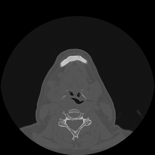 File:Bisphosphonate-related osteonecrosis of the jaw (Radiopaedia 71324-81642 Axial bone window 14).jpg