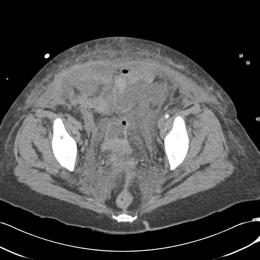 Bladder rupture post renal biopsy (Radiopaedia 30863-31572 Axial non-contrast 76).jpg