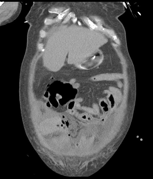Bladder rupture post renal biopsy (Radiopaedia 30863-31572 Coronal non-contrast 15).jpg