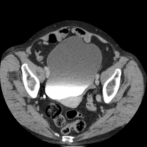 Bladder tumor detected on trauma CT (Radiopaedia 51809-57609 C 118).jpg