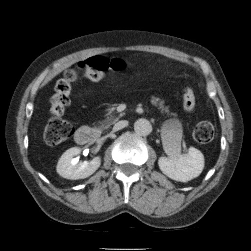 Bladder tumor detected on trauma CT (Radiopaedia 51809-57609 C 53).jpg