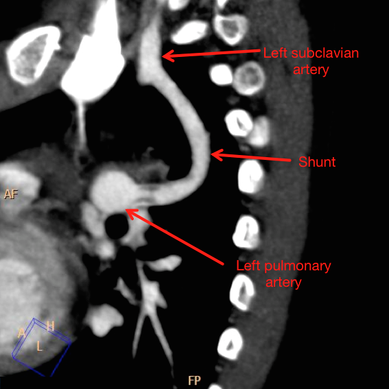 File:Blalock-Taussig shunt (annotated image) (Radiopaedia 41040-43788 Annotated image 1).png
