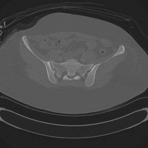 Blood in uterovesical and rectovesical pouch in trauma patient (Radiopaedia 34090-35340 Axial bone window 54).png