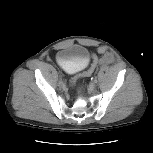 Blunt abdominal trauma with solid organ and musculoskelatal injury with active extravasation (Radiopaedia 68364-77895 Axial C+ delayed 112).jpg