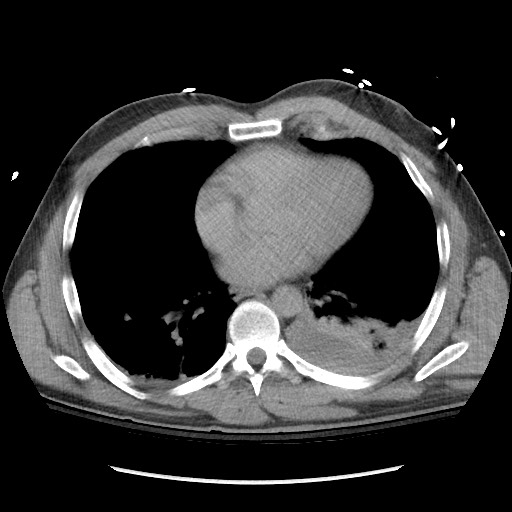 Blunt abdominal trauma with solid organ and musculoskelatal injury with active extravasation (Radiopaedia 68364-77895 Axial C+ delayed 4).jpg