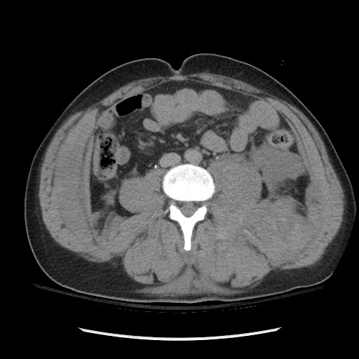 File:Blunt abdominal trauma with solid organ and musculoskelatal injury with active extravasation (Radiopaedia 68364-77895 Axial C+ delayed 80).jpg