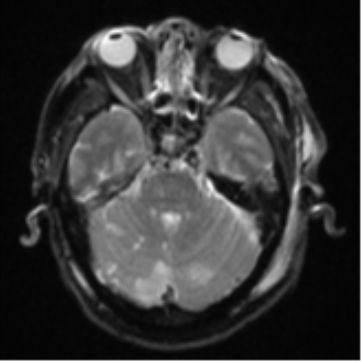 Blunt cerebrovascular injury (Radiopaedia 53682-59745 Axial DWI 10).png