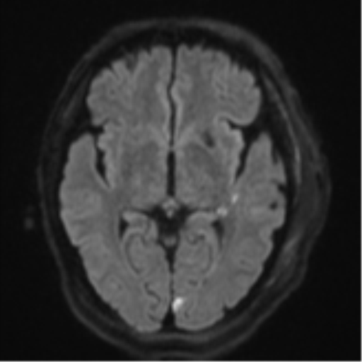 Blunt cerebrovascular injury (Radiopaedia 53682-59745 Axial DWI 45).png