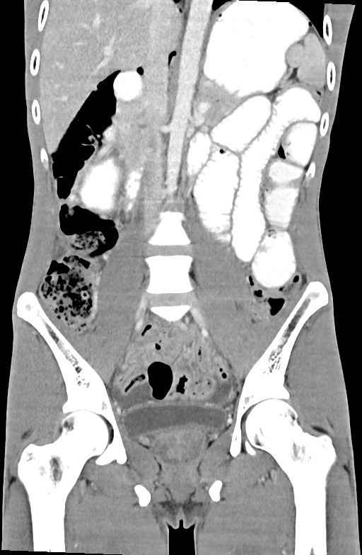 Blunt injury to the small bowel (Radiopaedia 74953-85987 B 51).jpg