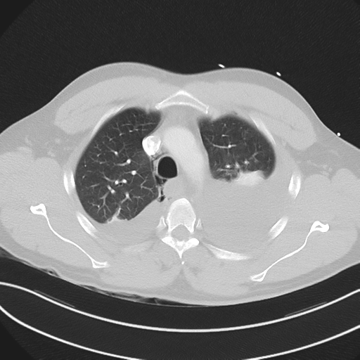Boerhaave syndrome (Radiopaedia 39382-41660 Axial lung window 15).png