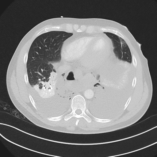Boerhaave syndrome (Radiopaedia 39382-41660 Axial lung window 40).png