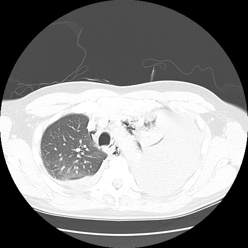 File:Boerhaave syndrome (Radiopaedia 59796-67310 Axial lung window 20).jpg
