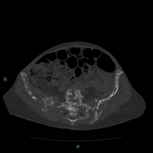 File:Bone metastases from untreated breast cancer (Radiopaedia 42973-46219 Axial bone window 151).jpg