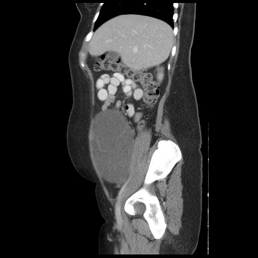 File:Borderline mucinous tumor (ovary) (Radiopaedia 78228-90808 B 21).jpg