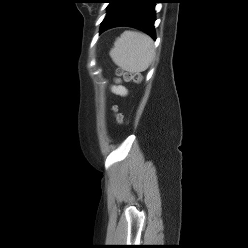 File:Borderline mucinous tumor (ovary) (Radiopaedia 78228-90808 B 57).jpg