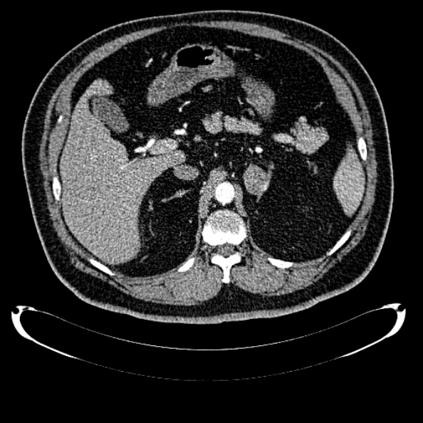 File:Bosniak renal cyst - type IV (Radiopaedia 24244-24518 B 90).jpg