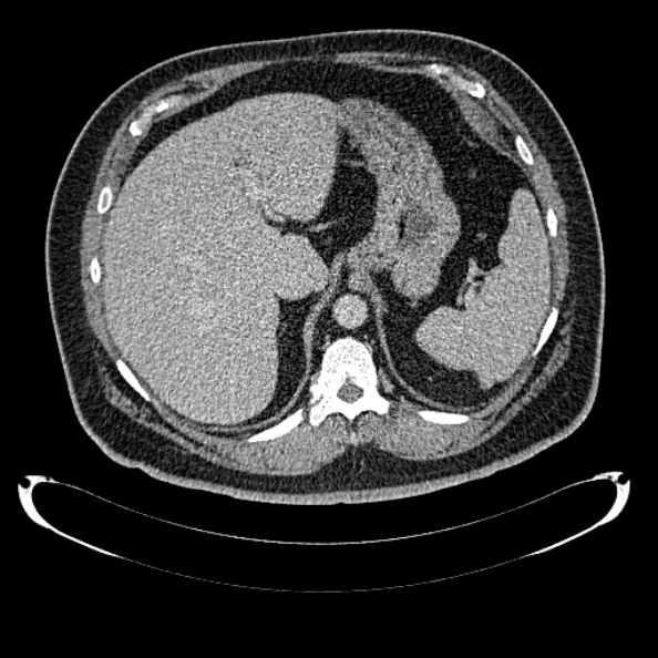 File:Bosniak renal cyst - type IV (Radiopaedia 24244-24518 C 59).jpg