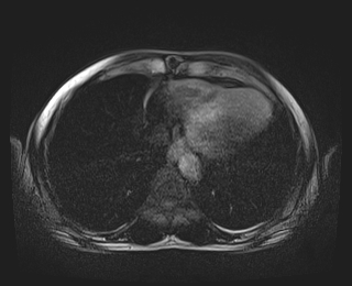 Bouveret syndrome (Radiopaedia 61017-68856 Axial T1 fat sat 1).jpg