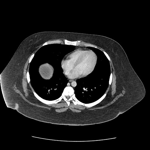 Bowel and splenic infarcts in acute lymphocytic leukemia (Radiopaedia 61055-68915 A 11).jpg