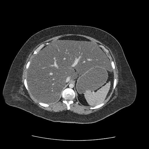Bowel and splenic infarcts in acute lymphocytic leukemia (Radiopaedia 61055-68915 A 37).jpg