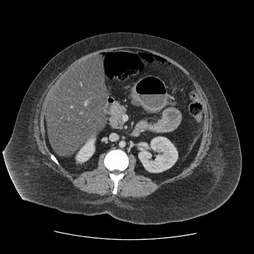 Bowel and splenic infarcts in acute lymphocytic leukemia (Radiopaedia 61055-68915 A 60).jpg