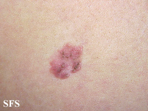 Bowen'S Disease (Dermatology Atlas 3).jpg