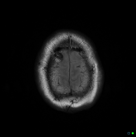 File:Brain death on MRI and CT angiography (Radiopaedia 42560-45689 Axial FLAIR 15).jpg