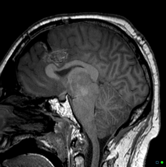 Brain death on MRI and CT angiography (Radiopaedia 42560-45689 Sagittal T1 28).jpg