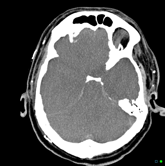 Brain death on MRI and CT angiography (Radiopaedia 42560-45841 B 34).jpg